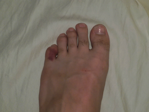 Judging by the nasty color of his toe, we're pretty sure it broke.