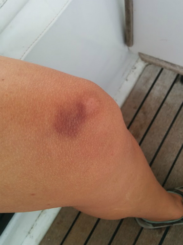 Large bruise on knee